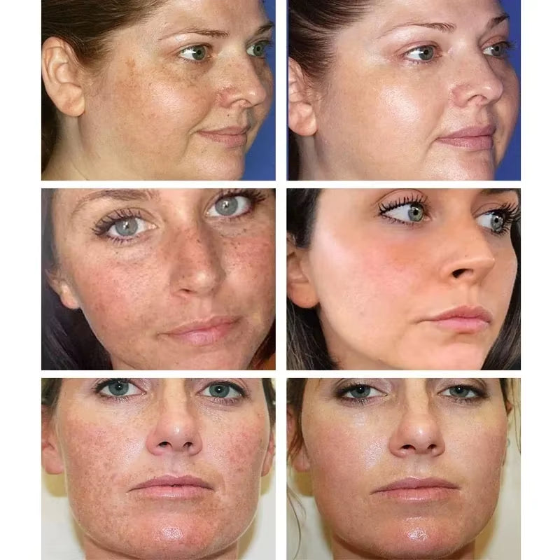 Whitening Freckle Cream Remove Dark Spots Remove Melasma anti Freckle Cream Fade Pigmentation Anti-Aging Light Skin Care